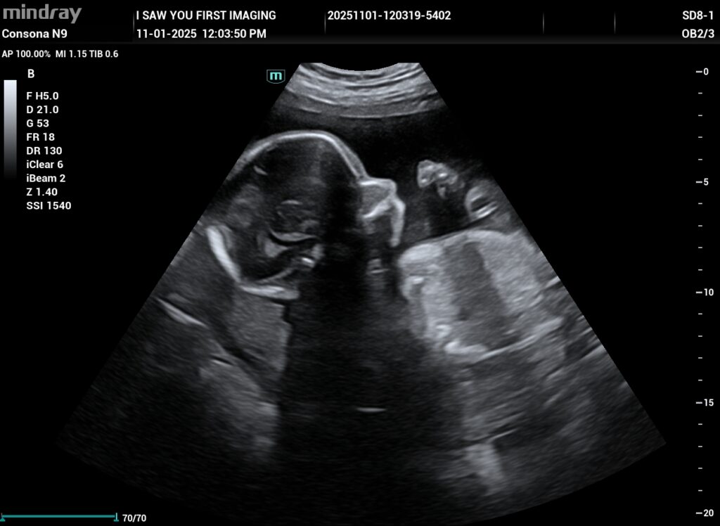 pregnancy-ultrasound